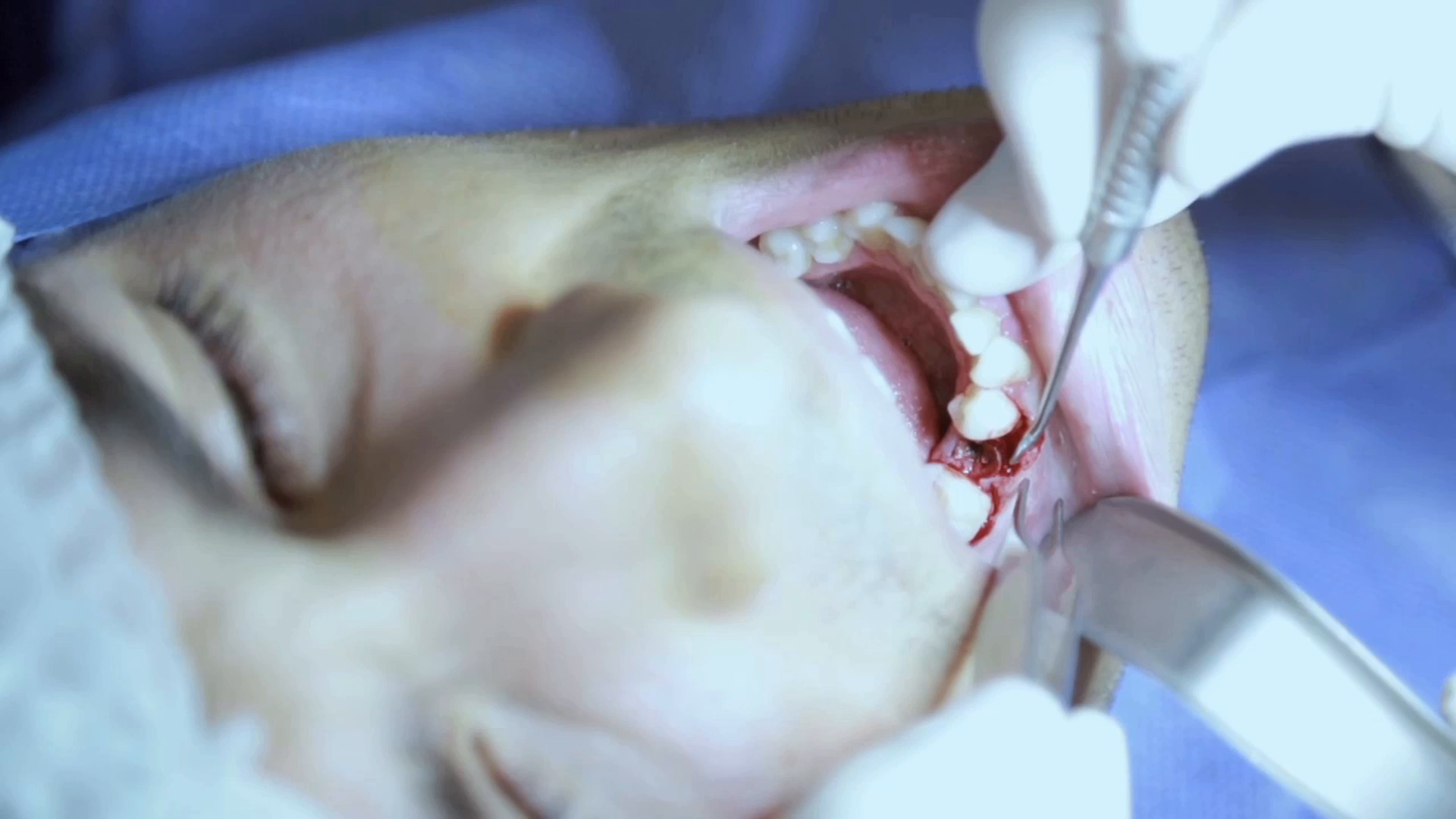 Thumbnail for Beer Tooth Implant